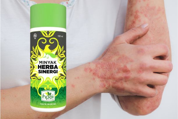 Minyak Herba Sinergi untuk Penyakit Kulit Solusi Alami untuk Masalah Kulit Anda